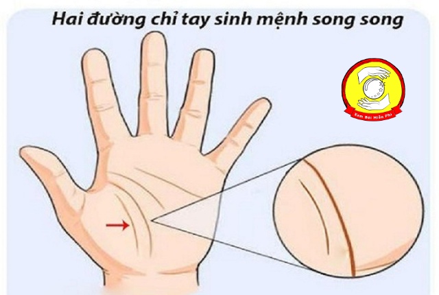 Đường chỉ tay sinh mệnh song song